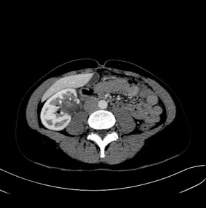 Die CT-Kontrolle wegen Flankenschmerz rechts 2 Tage post Embolisation zeigt die intakte vaskuläre Integrität des Nierenorgans rechts 