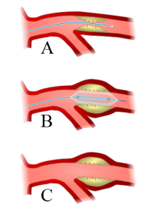 Angioplasty-scheme
